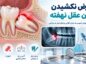 دندان عقل نهفته